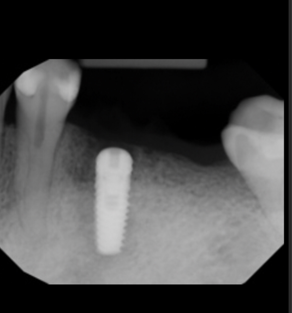 Will this implant fail because of low torque of 15 ncm?