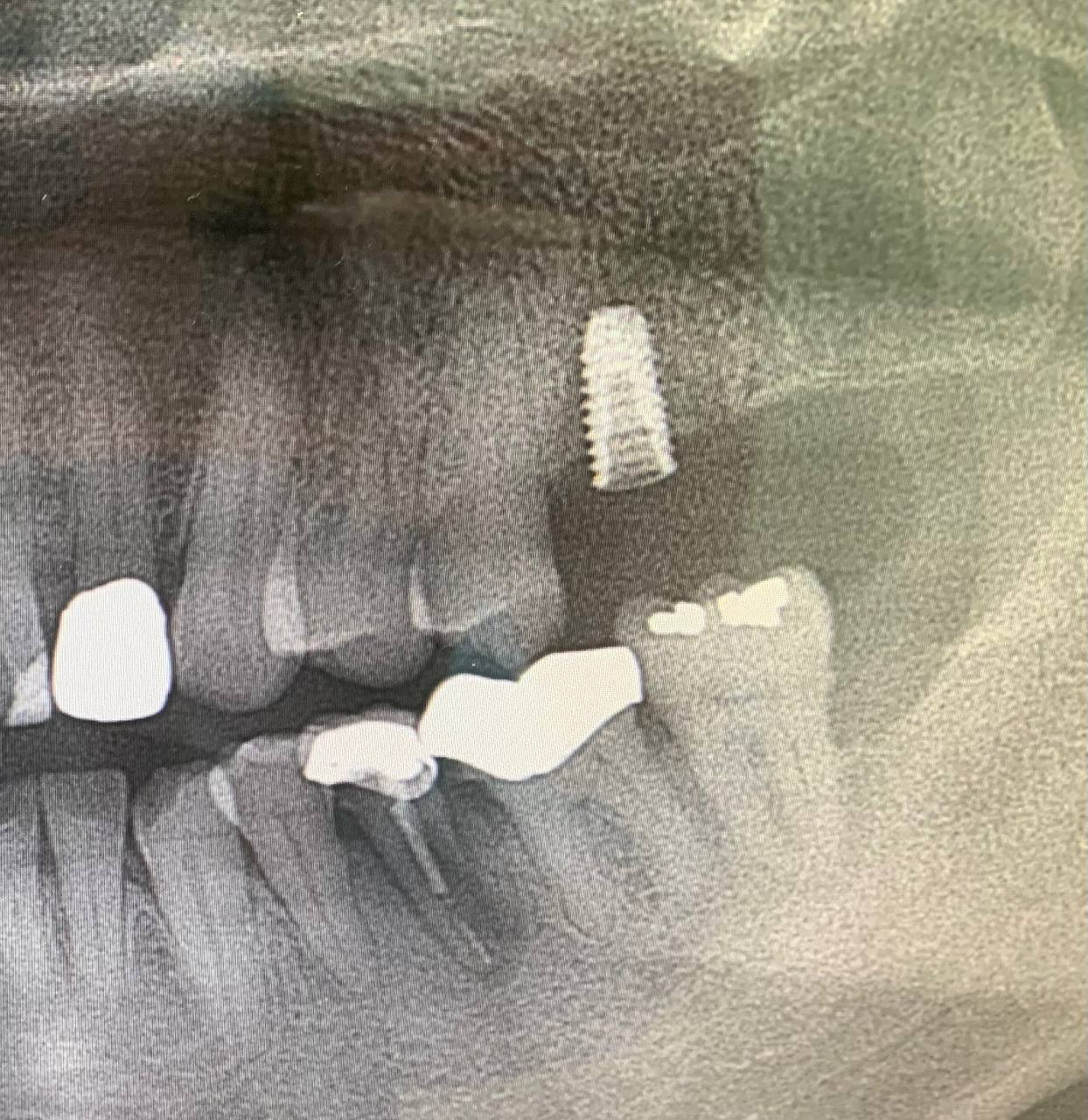 Implant is supracrestal, can it be restored?