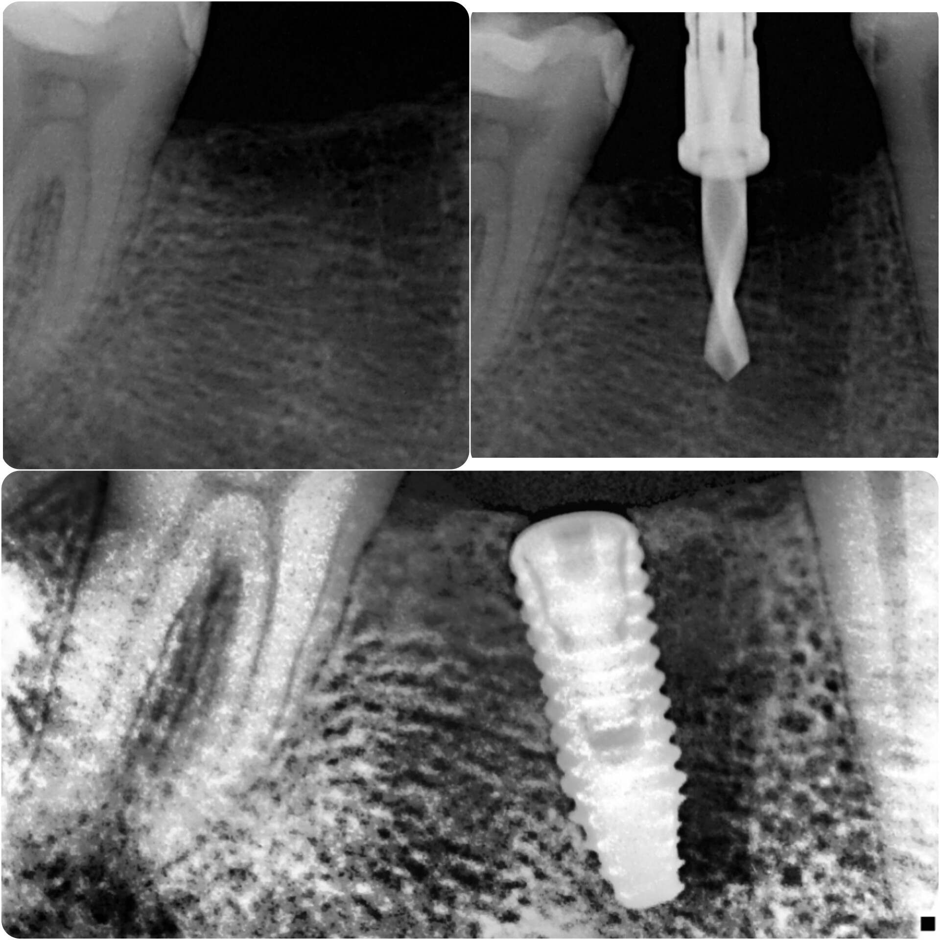 Consequences of the tilted implant?