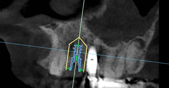 Not enough space between tooth and implant for another implant?