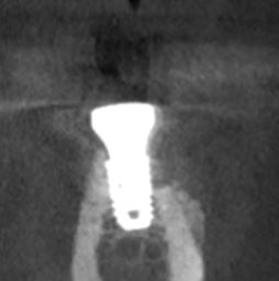 Buccal bone loss after implant placement