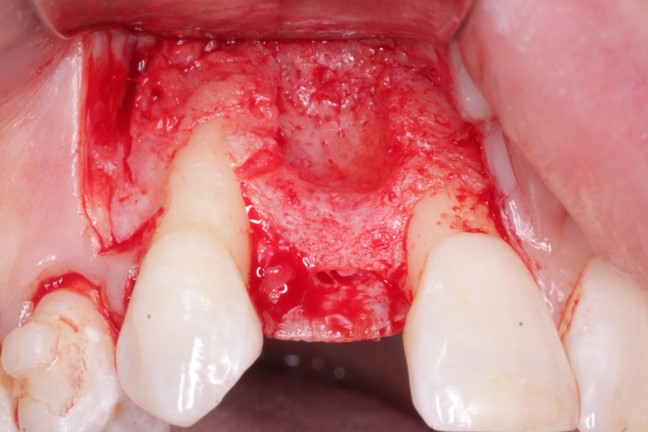 Using a Flexible Porcine Collagen Membrane over a Graft