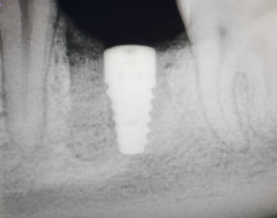 Implant journey from 2016