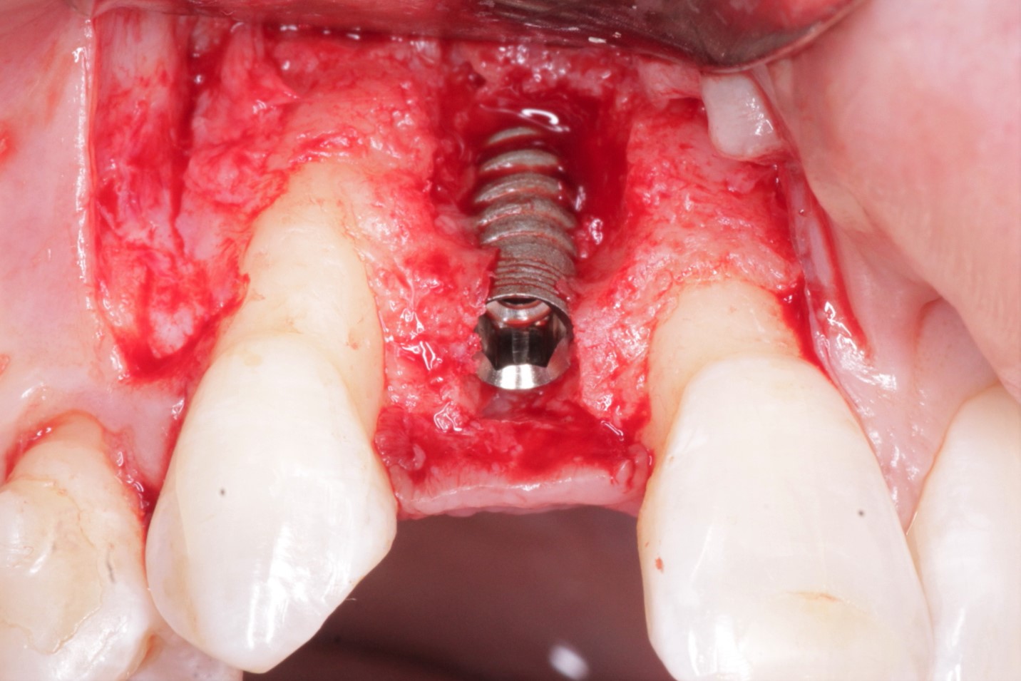 Grafting around implant at time of placement: predictable?