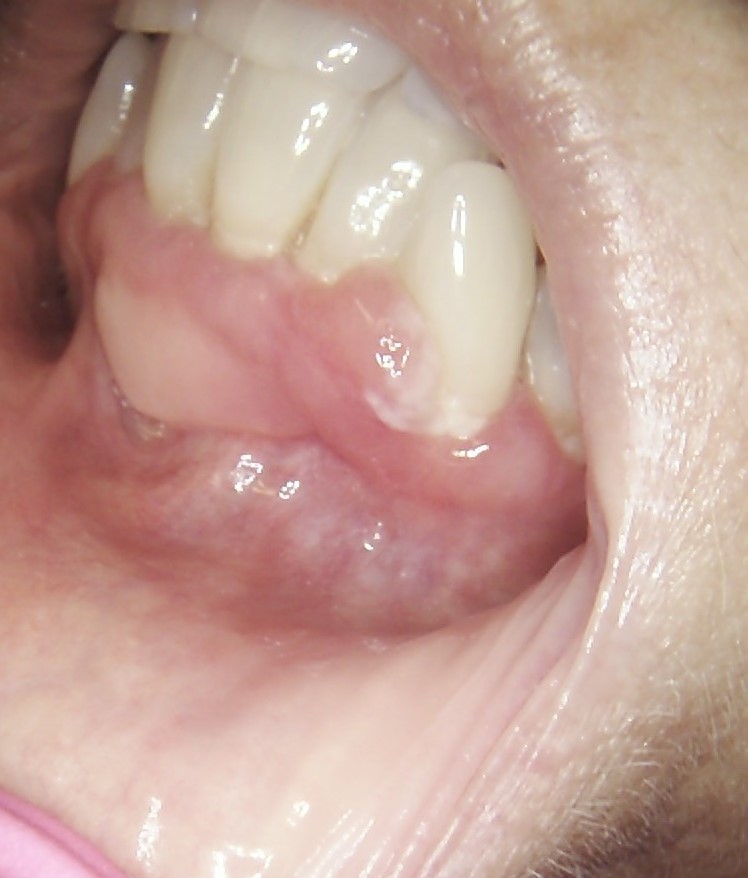 Oral Squamous Cell Carcinoma