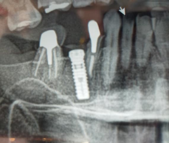 Please tell me what this implant is it