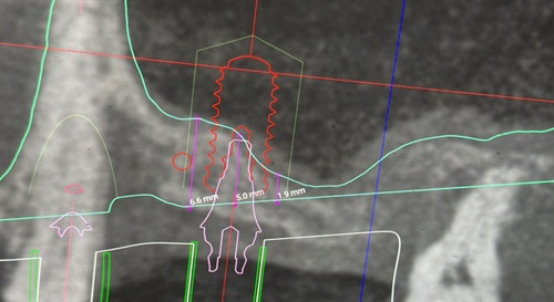 Does it look like the sinus membrane is perforated?